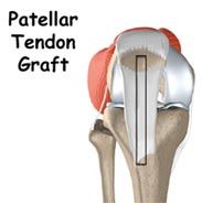 ACL Tear Treated Surgically