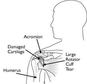 Rotator Cuff Tear Arthropathy