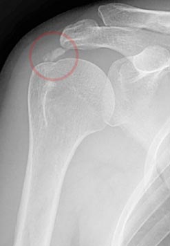 Shoulder Calcific Tendonitis