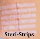 Steri Strips