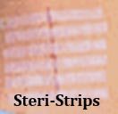 Steri Strips