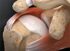 Superior Capsular Reconstruction