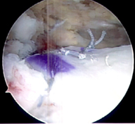 Images show before and after of a superior capsule reconstruction of the shoulder