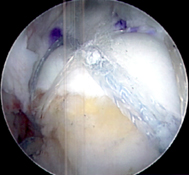 Images show before and after of a superior capsule reconstruction of the shoulder