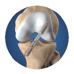 Surgical Treatment of an Anterior Cruciate Ligament Tear