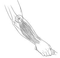 Tennis Elbow Symptoms