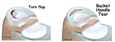 Types of Meniscus Tears