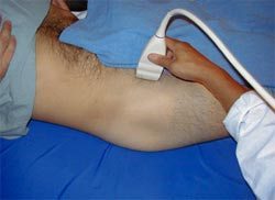 Ultrasound Scan of Hip