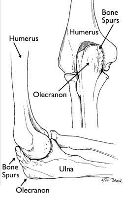 Valgus Extension Overload